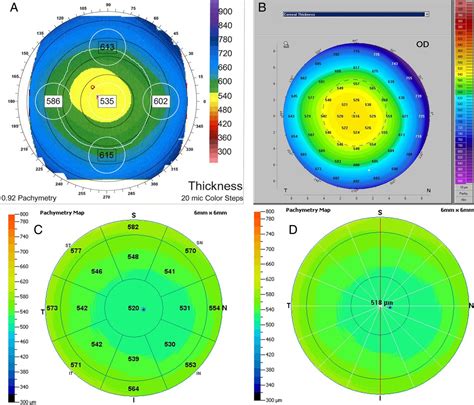 measurement of the thickness of the cornea is known as|normal corneal thickness chart.